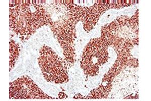 Immunohistochemistry on paraffin section of human breast carcinoma (ErbB2/Her2 anticorps)