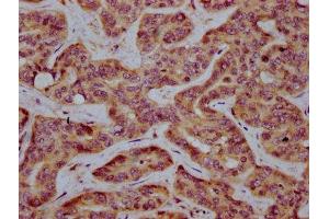 IHC image of ABIN7155184 diluted at 1:400 and staining in paraffin-embedded human liver cancer performed on a Leica BondTM system.