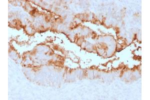 Formalin-fixed, paraffin-embedded human Endometrial Carcinoma stained with MUC16 Rabbit Recombinant Monoclonal Antibody (OCA125/2349R). (Recombinant MUC16 anticorps)
