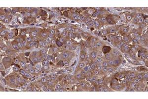 ABIN6273842 at 1/100 staining Human liver cancer tissue by IHC-P. (CMKLR1 anticorps  (Internal Region))