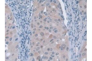 DAB staining on IHC-P; Samples: Human Breast cancer Tissue (GFM1 anticorps  (AA 1-158))