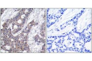 Immunohistochemical analysis of paraffin-embedded human breast carcinoma tissue using Stathmin 1(Phospho-Ser16) Antibody(left) or the same antibody preincubated with blocking peptide(right). (Stathmin 1 anticorps  (pSer16))