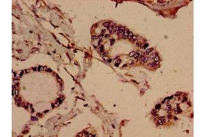 Immunohistochemistry analysis of human pancreatic cancer using ABIN7151520 at dilution of 1:100