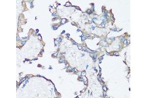 Immunohistochemistry of paraffin-embedded Human lung cancer using SRC Polyclonal Antibody at dilution of 1:100 (40x lens). (Src anticorps)