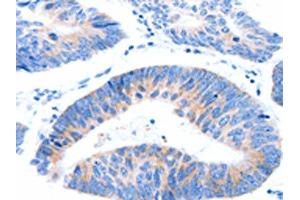 The image on the left is immunohistochemistry of paraffin-embedded Human colon cancer tissue using ABIN7191546(MUC3A Antibody) at dilution 1/60, on the right is treated with synthetic peptide.