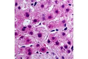 Immunohistochemical analysis of Cytochrome b5A staining in human liver cancer formalin fixed paraffin embedded tissue section.