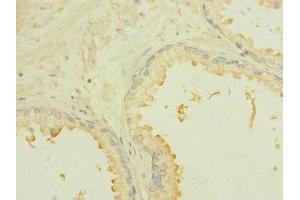 Immunohistochemistry of paraffin-embedded human prostate cancer using ABIN7168444 at dilution of 1:100 (ROBO2 anticorps  (AA 450-660))