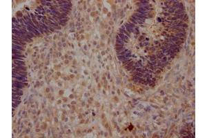 IHC image of ABIN7172750 diluted at 1:200 and staining in paraffin-embedded human ovarian cancer performed on a Leica BondTM system.