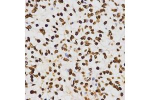 Immunohistochemistry of paraffin-embedded human liver cancer using DiMethyl-Histone H3-K27 antibody.