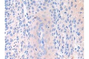 Detection of IL7 in Human Skin cancer Tissue using Polyclonal Antibody to Interleukin 7 (IL7) (IL-7 anticorps  (AA 26-177))