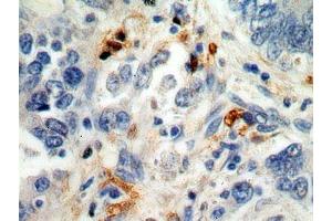 IHC analysis of paraffin-embedded human stomach cancer cells using S100A8 Antibody (dilution 1:100). (S100A8 anticorps)