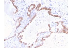 Formalin-fixed, paraffin-embedded human Colon Carcinoma stained with CK18 Rabbit Recombinant Monoclonal Antibody (KRT18/2808R).