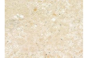ABIN6256496 and ABIN6277795 at 1/100 staining human astrocytoma by IHC-P.