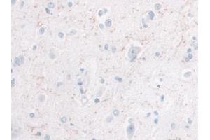 IHC-P analysis of Human Glioma Tissue, with DAB staining. (IL-10 anticorps  (AA 1-178))