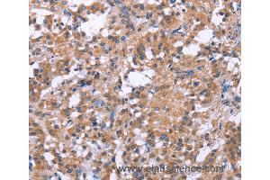 Immunohistochemistry of Human gastric cancer using SLC52A1 Polyclonal Antibody at dilution of 1:40 (GPR172B anticorps)