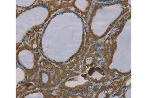 Immunohistochemistry of Human esophagus cancer using S100A6 Polyclonal Antibody at dilution of 1:35 (S100A6 anticorps)