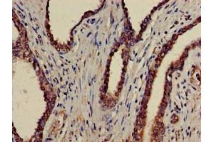 Immunohistochemistry of paraffin-embedded human prostate cancer using ABIN7145034 at dilution of 1:100 (ATAD1 anticorps  (AA 289-350))