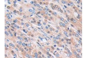 Detection of SCAF11 in Human Prostate cancer Tissue using Polyclonal Antibody to Protein SCAF11 (SCAF11)