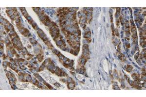 ABIN6267165 at 1/100 staining Human thyroid cancer tissue by IHC-P. (DLG4 anticorps  (pTyr236, pTyr240))