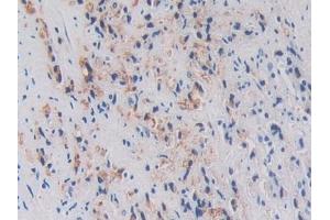 Detection of ODC in Human Prostate cancer Tissue using Polyclonal Antibody to Ornithine Decarboxylase (ODC)