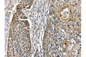 The image on the left is immunohistochemistry of paraffin-embedded Human esophagus cancer tissue using ABIN7130610(PHLPP1 Antibody) at dilution 1/35, on the right is treated with fusion protein. (PHLPP1 anticorps)