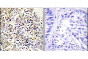 Immunohistochemistry analysis of paraffin-embedded human lung carcinoma tissue, using ASC Antibody.
