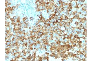 Formalin-fixed, paraffin-embedded human Melanoma stained with gp100 Mouse Monoclonal Antibody (PMEL/2039). (Melanoma gp100 anticorps  (AA 376-502))