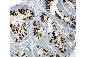 IHC-P: p107 antibody testing of human intestinal cancer tissue (p107 anticorps  (C-Term))