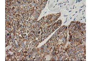 Immunohistochemical staining of paraffin-embedded Adenocarcinoma of Human breast tissue using anti-AK4 mouse monoclonal antibody. (AK4 anticorps)