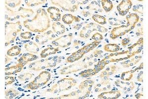 ABIN6265577 and ABIN6273331 at 1/100 staining Human kidney cancer and adjacent normal tissues by IHC-P. (TIMM9 anticorps  (C-Term))