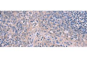 Immunohistochemistry of paraffin-embedded Human tonsil tissue using ITPR2 Polyclonal Antibody at dilution of 1:65(x200)