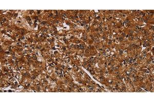 Immunohistochemistry of paraffin-embedded Human prostate cancer using ACP6 Polyclonal Antibody at dilution of 1:30 (ACP6 anticorps)