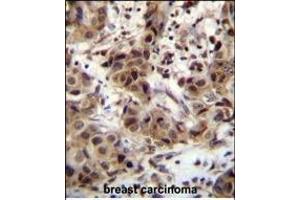 ZN Antibody (N-term) (ABIN655359 and ABIN2844918) immunohistochemistry analysis in formalin fixed and paraffin embedded human breast carcinoma followed by peroxidase conjugation of the secondary antibody and DAB staining. (ZNF321P anticorps  (N-Term))