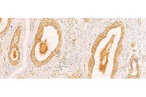 Immunohistochemistry of paraffin-embedded Human breast cancer tissue using ZNF580 Polyclonal Antibody at dilution of 1:40(x200) (ZNF580 anticorps)