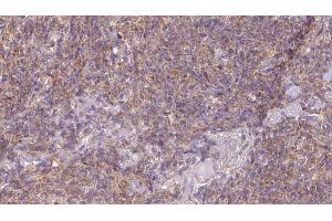 ABIN6273189 at 1/100 staining Human lymph cancer tissue by IHC-P. (ACAA1 anticorps  (N-Term))
