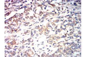 Immunohistochemical analysis of paraffin-embedded bladder cancer tissues using CALR mouse mAb with DAB staining. (Calreticulin anticorps  (AA 18-417))