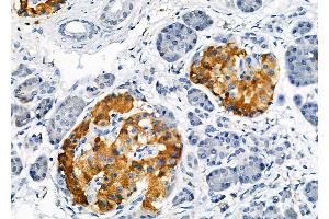 ABIN6259503 and ABIN6273960 at 1/100 staining Human pancreatic cancer and adjacent nomal tissues by IHC-P.