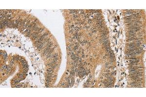 Immunohistochemistry of paraffin-embedded Human colon cancer using ARHGAP25 Polyclonal Antibody at dilution of 1:40 (ARHGAP25 anticorps)