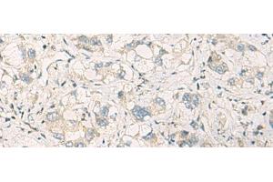 Immunohistochemistry of paraffin-embedded Human liver cancer tissue using SPSB2 Polyclonal Antibody at dilution of 1:70(x200) (SPSB2 anticorps)