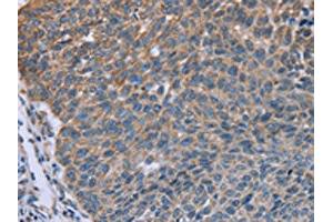The image on the left is immunohistochemistry of paraffin-embedded Human lung cancer tissue using ABIN7129622(GNAI3 Antibody) at dilution 1/30, on the right is treated with fusion protein. (GNAI3 anticorps)