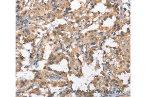 Immunohistochemistry of Human breast cancer using HGF Polyclonal Antibody at dilution of 1:65 (HGF anticorps)