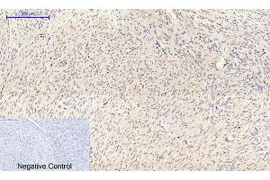 Immunohistochemical analysis of paraffin-embedded human uterus cancer tissue.