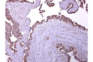 IHC-P Image GABA B Receptor 1 antibody [N2C1], Internal detects GABA B Receptor 1 protein at cytosol on human ovarian carcinoma by immunohistochemical analysis.
