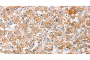 Immunohistochemistry of paraffin-embedded Human thyroid cancer tissue using SIGLEC9 Polyclonal Antibody at dilution 1:40 (SIGLEC9 anticorps)