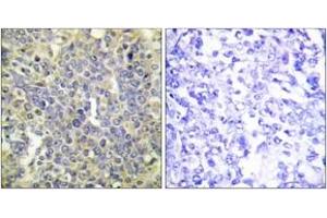 Immunohistochemistry analysis of paraffin-embedded human lung carcinoma, using Caspase 9 (Phospho-Thr125) Antibody. (Caspase 9 anticorps  (pThr125))