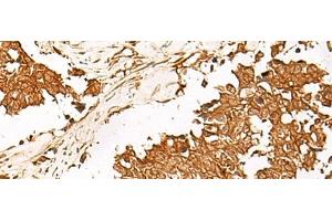 Immunohistochemistry of paraffin-embedded Human lung cancer tissue using HUS1 Polyclonal Antibody at dilution of 1:65(x200) (HUS1 anticorps)