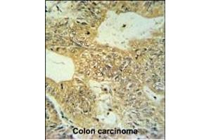 CLDN23 Antibody (C-term) (ABIN653789 and ABIN2843074) IHC analysis in formalin fixed and paraffin embedded colon carcinoma followed by peroxidase conjugation of the secondary antibody and DAB staining. (Claudin 23 anticorps  (C-Term))