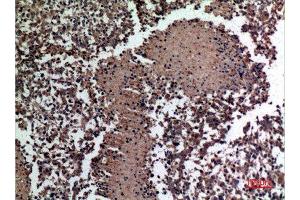 Immunohistochemistry (IHC) analysis of paraffin-embedded Human Lung Cancer, antibody was diluted at 1:100. (HSPBAP1 anticorps  (Internal Region))