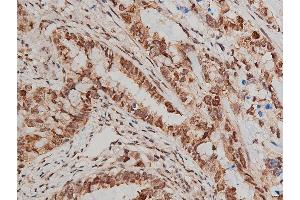 ABIN6266448 at 1/200 staining human lung cancer tissue sections by IHC-P.