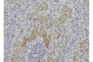 ABIN6276395 at 1/100 staining Human lung cancer tissue by IHC-P. (Endothelin 1 anticorps  (C-Term))